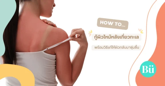 how to treat beach sunburn